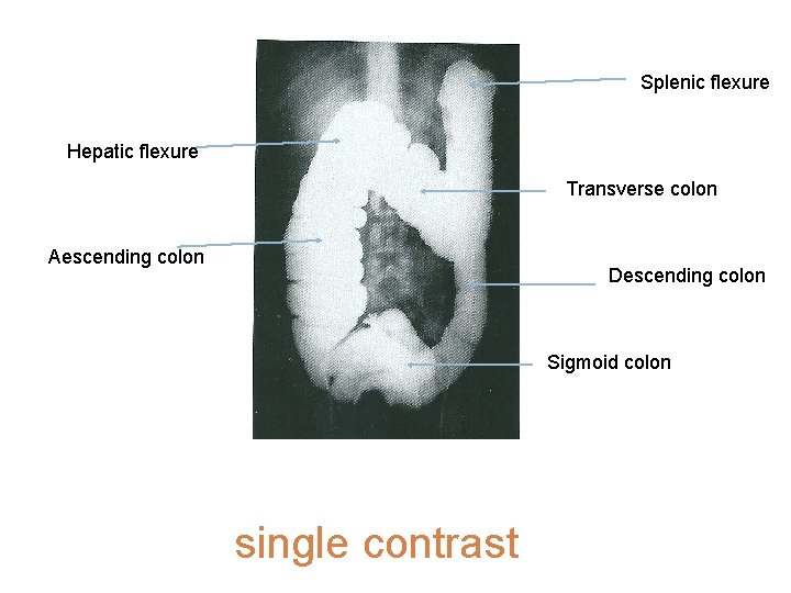 Splenic flexure Hepatic flexure Transverse colon Aescending colon Descending colon Sigmoid colon single contrast