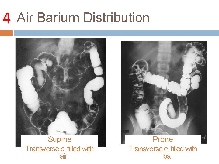 4 Air Barium Distribution Supine Transverse c. filled with air Prone Transverse c. filled