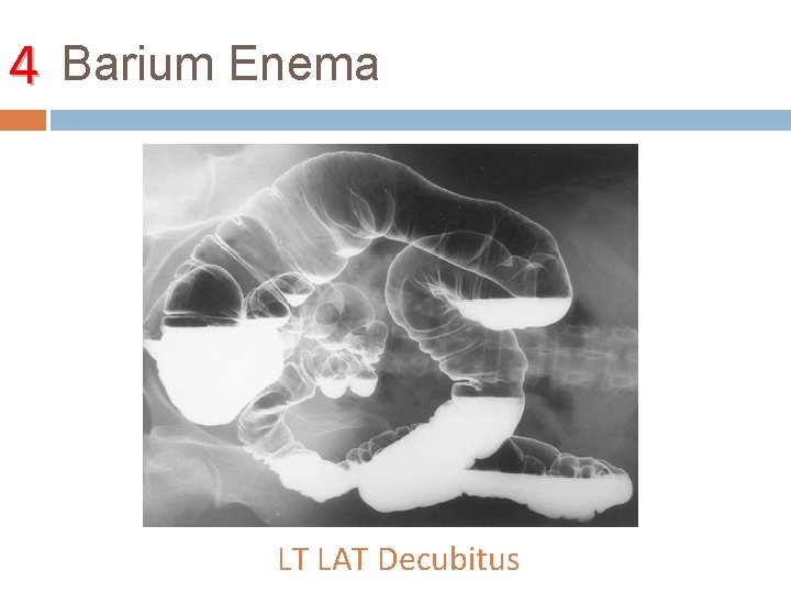 4 Barium Enema LT LAT Decubitus 