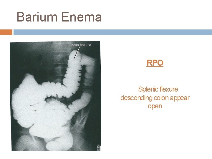 Barium Enema RPO Splenic flexure descending colon appear open 