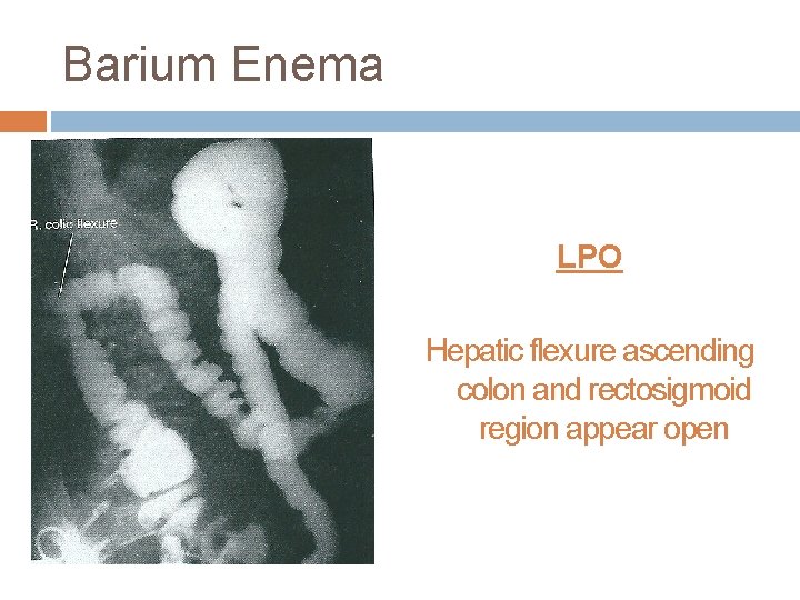 Barium Enema LPO Hepatic flexure ascending colon and rectosigmoid region appear open 