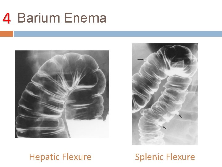 4 Barium Enema Hepatic Flexure Splenic Flexure 