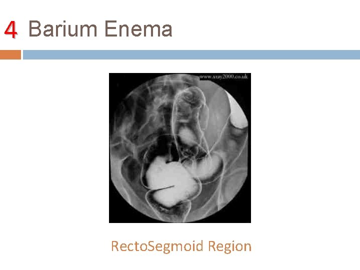 4 Barium Enema Recto. Segmoid Region 