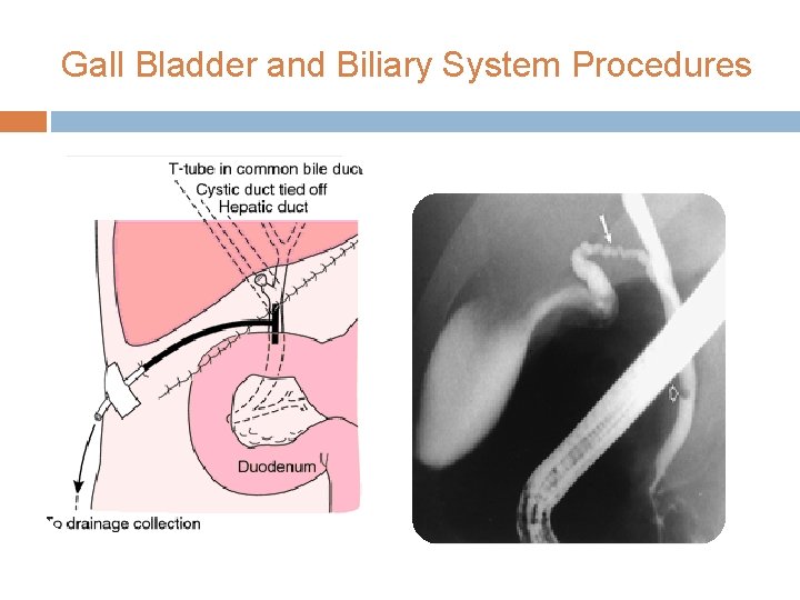 Gall Bladder and Biliary System Procedures 