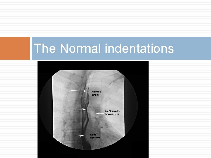 The Normal indentations 