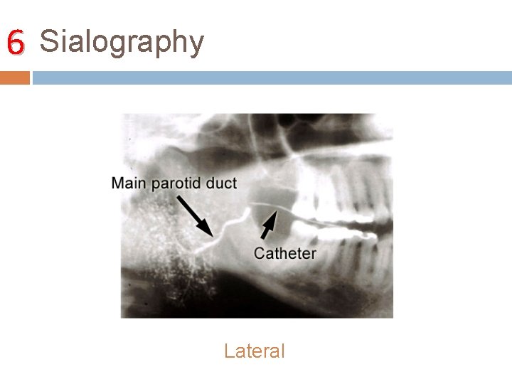 6 Sialography Lateral 