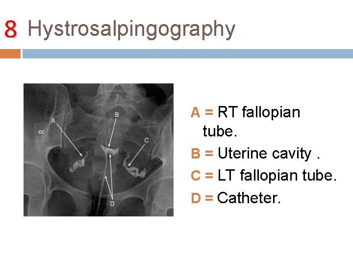 8 Hystrosalpingography A = RT fallopian tube. B = Uterine cavity. C = LT
