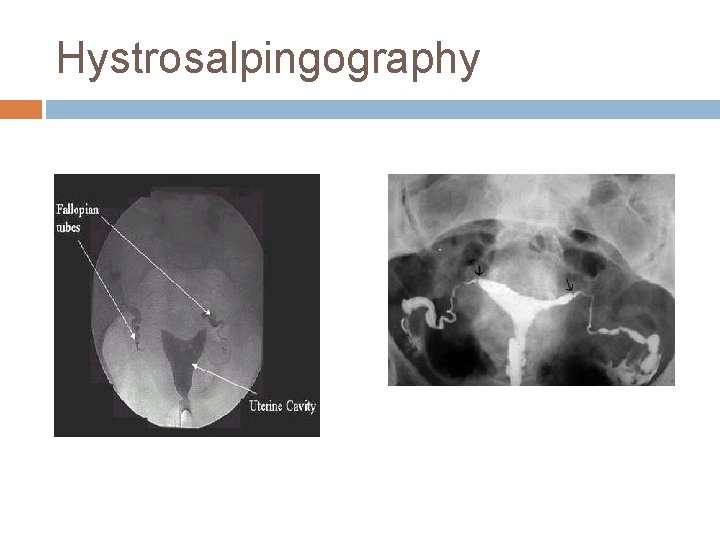 Hystrosalpingography 