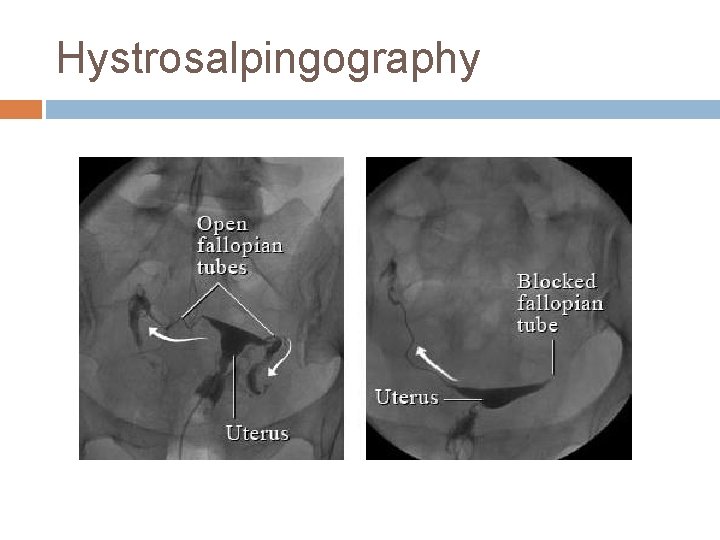 Hystrosalpingography 