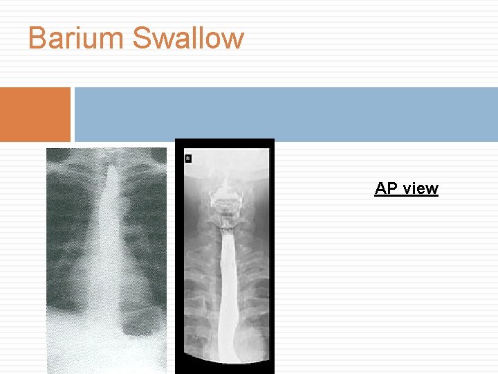 Barium Swallow AP view 