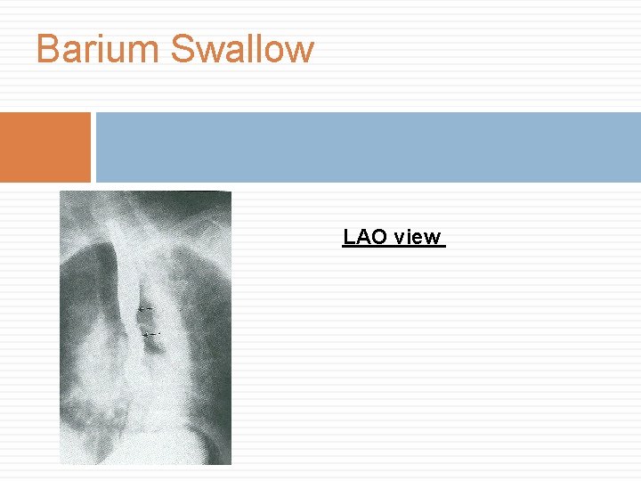 Barium Swallow LAO view 