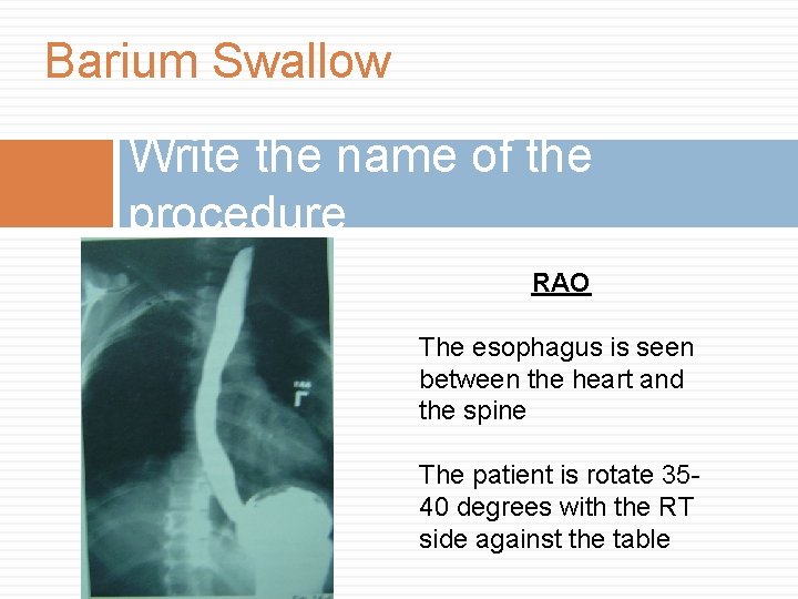 Barium Swallow Write the name of the procedure RAO The esophagus is seen between