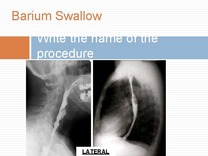 Barium Swallow Write the name of the procedure LATERAL 