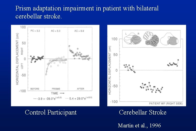 Prism adaptation impairment in patient with bilateral cerebellar stroke. Control Participant Cerebellar Stroke Martin