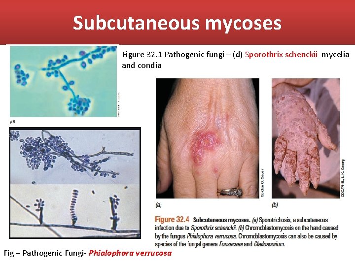 Subcutaneous mycoses Figure 32. 1 Pathogenic fungi – (d) Sporothrix schenckii mycelia and condia
