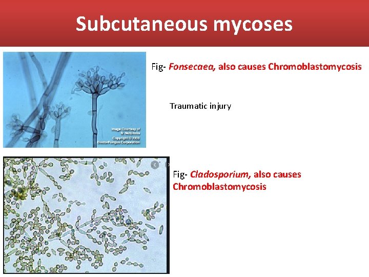 Subcutaneous mycoses Fig- Fonsecaea, also causes Chromoblastomycosis Traumatic injury Fig- Cladosporium, also causes Chromoblastomycosis