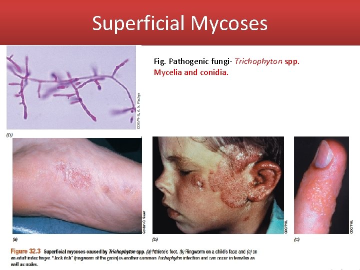 Superficial Mycoses Fig. Pathogenic fungi- Trichophyton spp. Mycelia and conidia. 