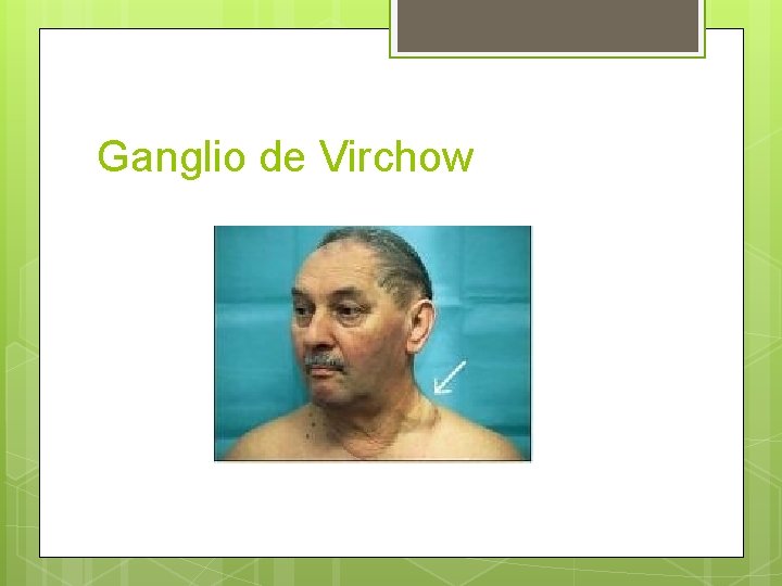 Ganglio de Virchow Ganglio de Virchow