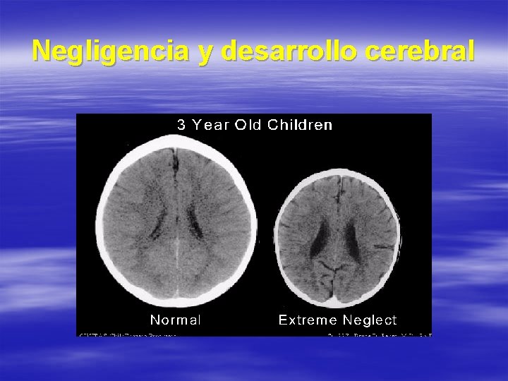 Negligencia y desarrollo cerebral 