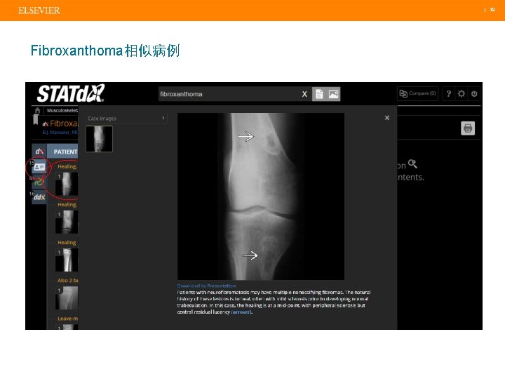  | 32 Fibroxanthoma相似病例 