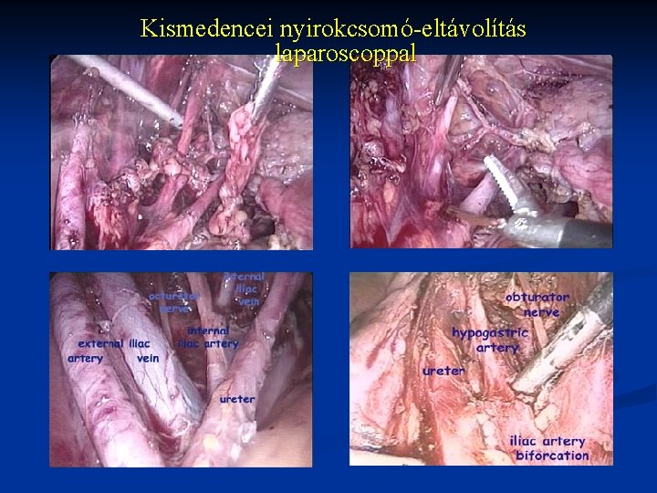 Kismedencei nyirokcsomó-eltávolítás laparoscoppal 