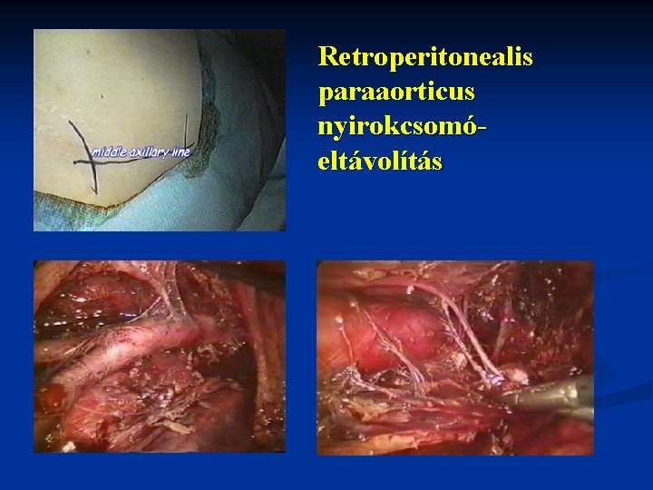 Retroperitonealis paraaorticus nyirokcsomóeltávolítás 