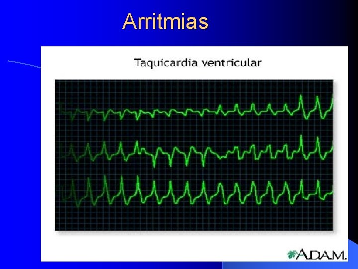 Arritmias 