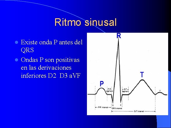 Ritmo sinusal Existe onda P antes del QRS l Ondas P son positivas en