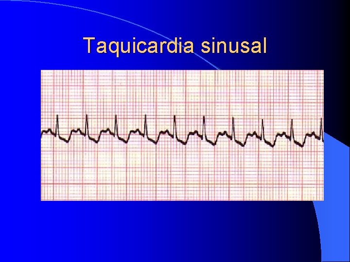 Taquicardia sinusal 