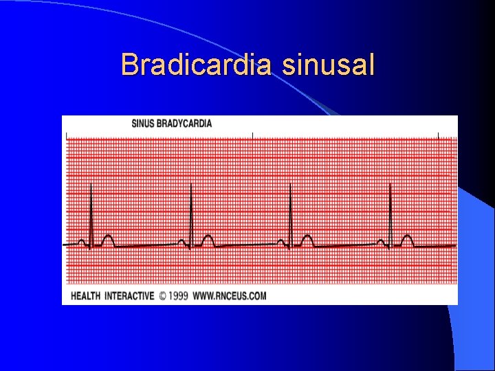 Bradicardia sinusal 