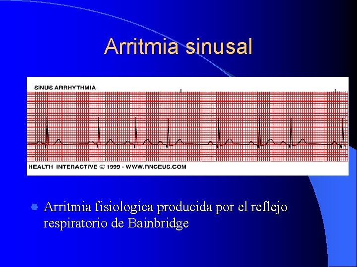 Arritmia sinusal l Arritmia fisiologica producida por el reflejo respiratorio de Bainbridge 