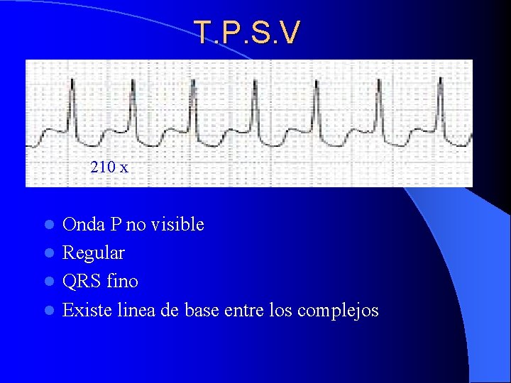 T. P. S. V 210 x Onda P no visible l Regular l QRS