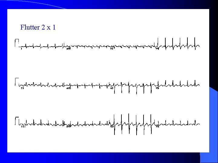 Flutter 2 x 1 