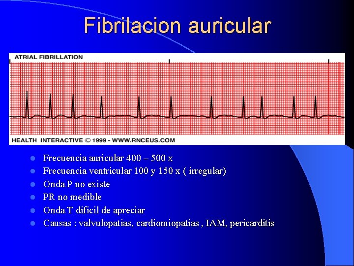 Fibrilacion auricular l l l Frecuencia auricular 400 – 500 x Frecuencia ventricular 100