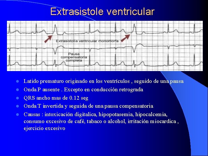 Extrasistole ventricular l l l Latido prematuro originado en los ventrículos , seguido de