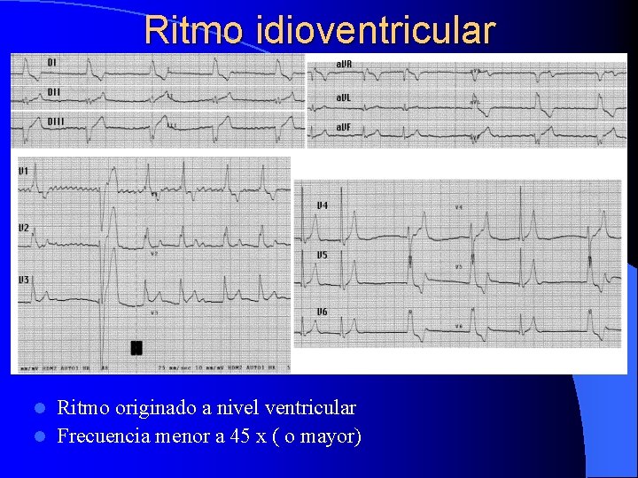 Ritmo idioventricular Ritmo originado a nivel ventricular l Frecuencia menor a 45 x (