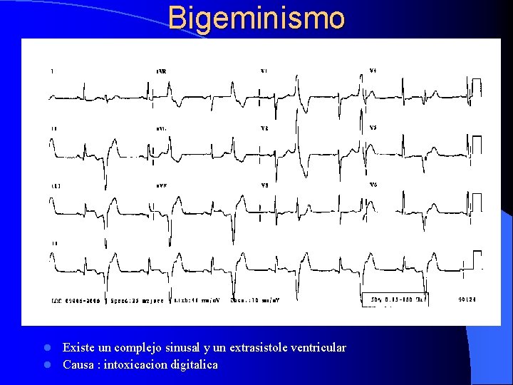 Bigeminismo Existe un complejo sinusal y un extrasistole ventricular l Causa : intoxicacion digitalica