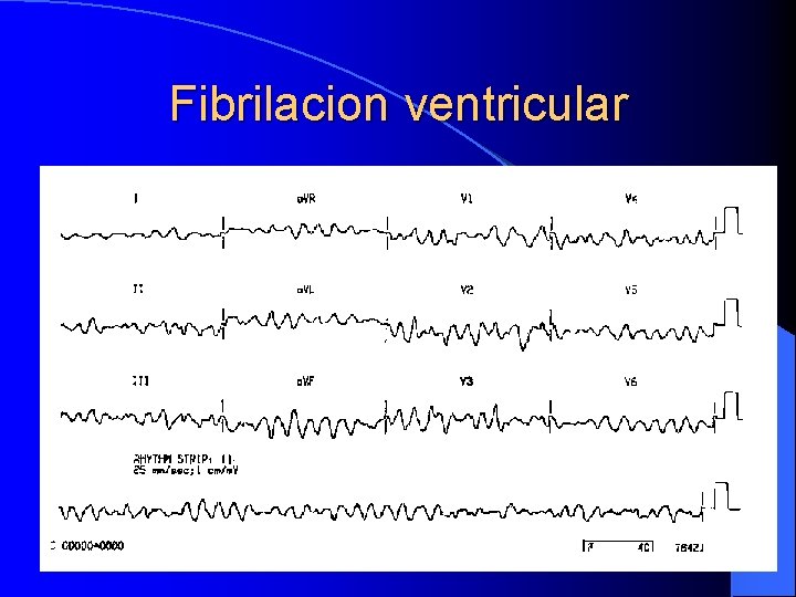 Fibrilacion ventricular 