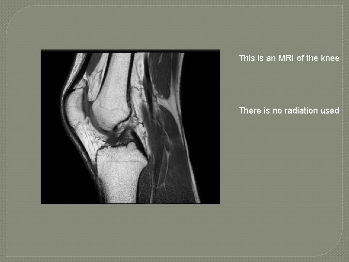 This is an MRI of the knee There is no radiation used 