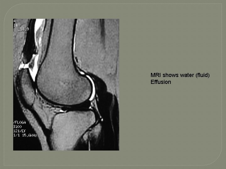 MRI shows water (fluid) Effusion 