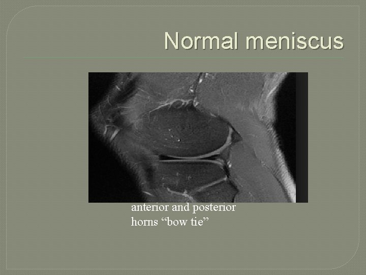 Normal meniscus anterior and posterior horns “bow tie” 