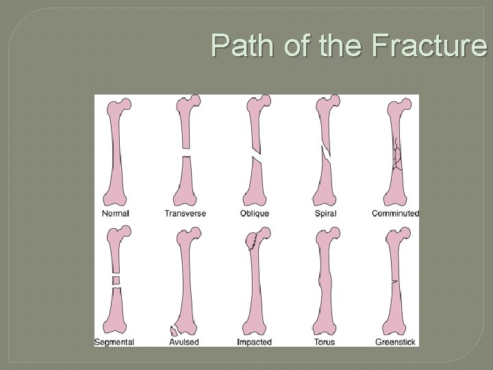Path of the Fracture 