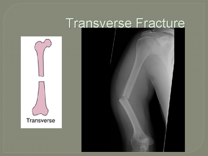 Transverse Fracture 