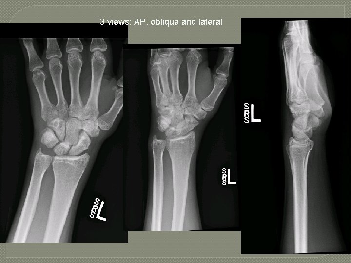 3 views: AP, oblique and lateral 