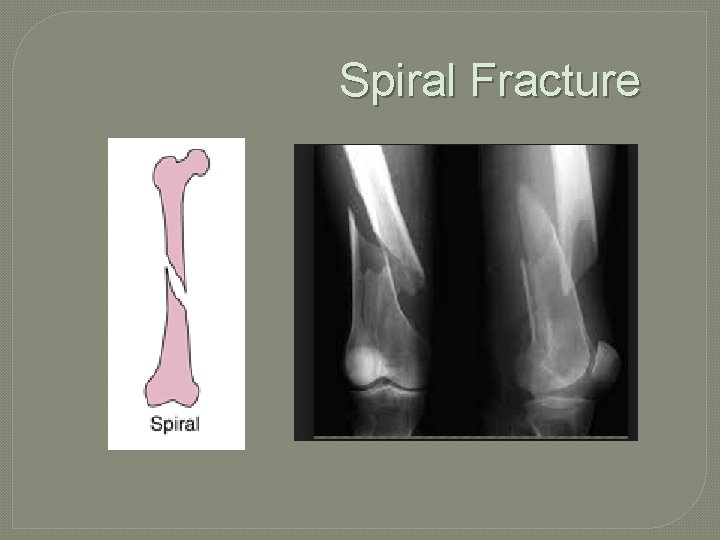 Spiral Fracture 