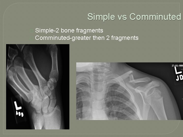 Simple vs Comminuted Simple-2 bone fragments � Comminuted-greater then 2 fragments � 