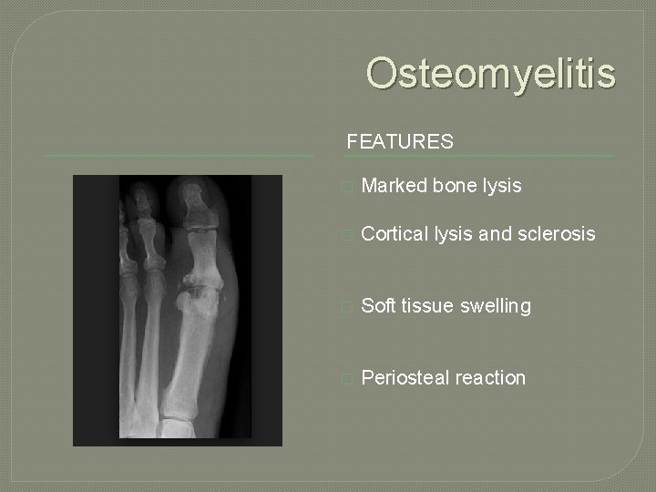 Osteomyelitis FEATURES � Marked bone lysis � Cortical lysis and sclerosis � Soft tissue