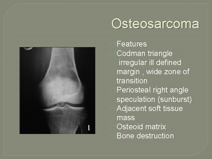 Osteosarcoma � Features � Codman triangle � irregular ill defined margin , wide zone