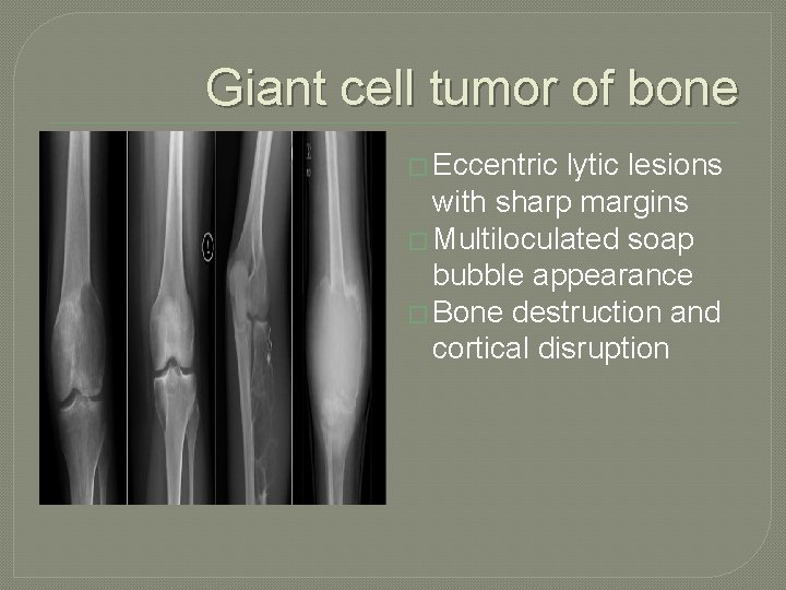 Giant cell tumor of bone � Eccentric lytic lesions with sharp margins � Multiloculated