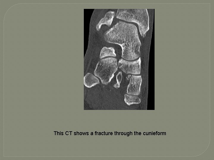 This CT shows a fracture through the cunieform 